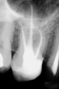 Radiologia digitale ai fosfori